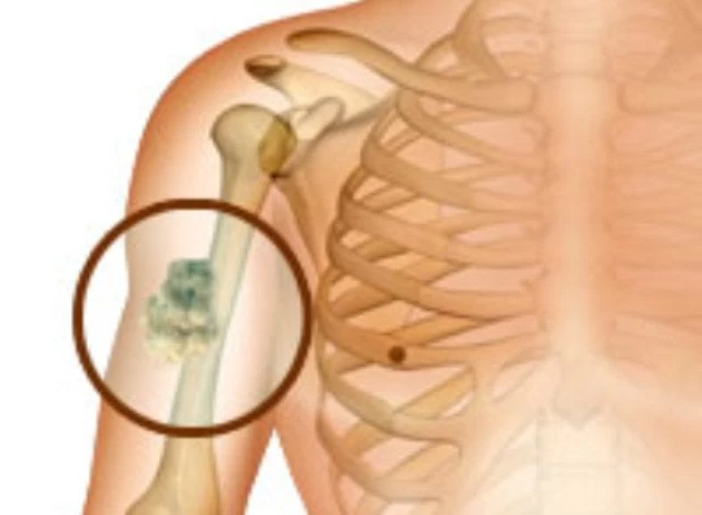 Καρκίνος στα οστά: Τι είναι το οστεοσάρκωμα και τι κάνει στον οργανισμό μας